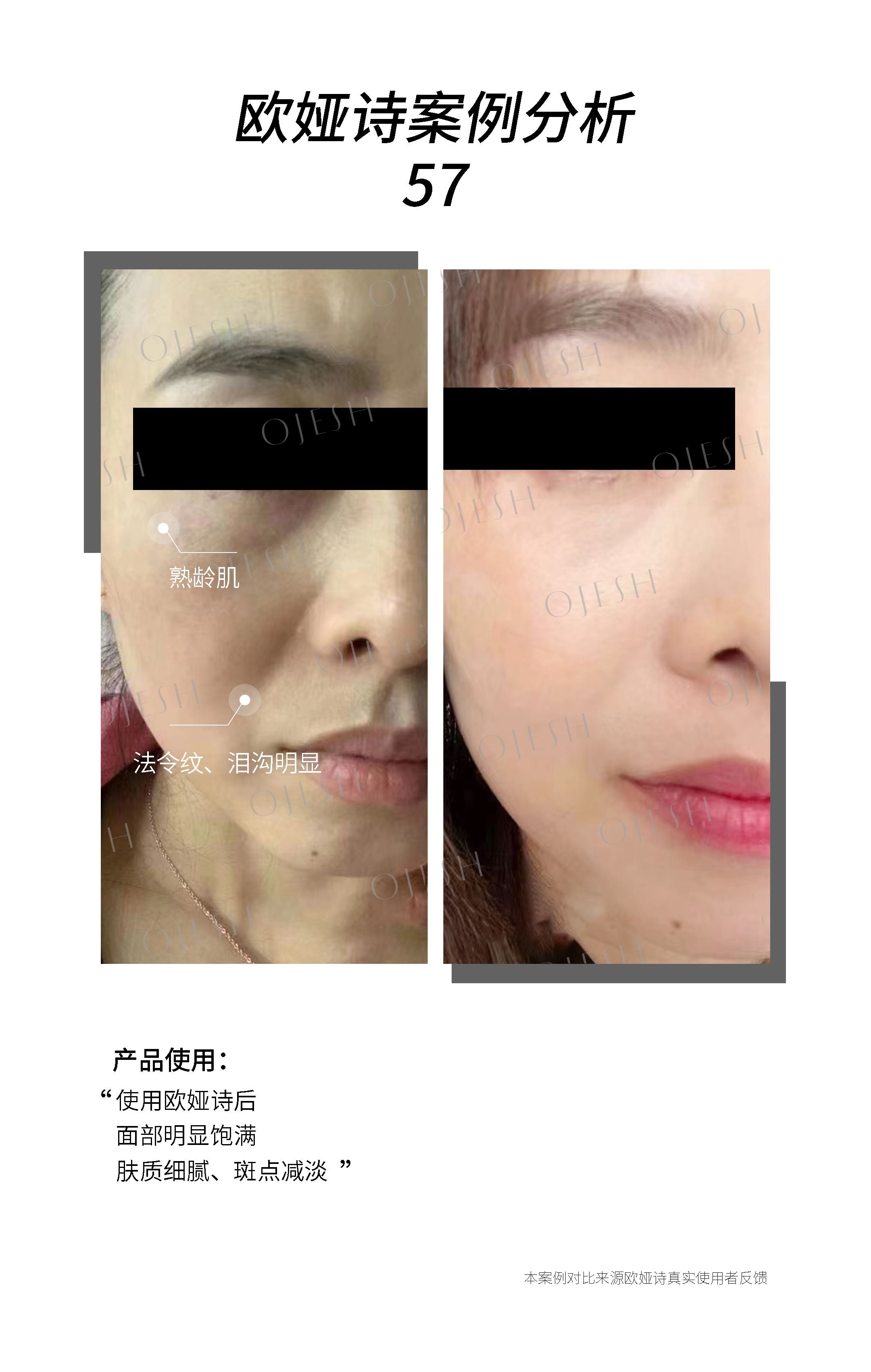 Ojesh 蓝瓶玻尿酸 7支/盒